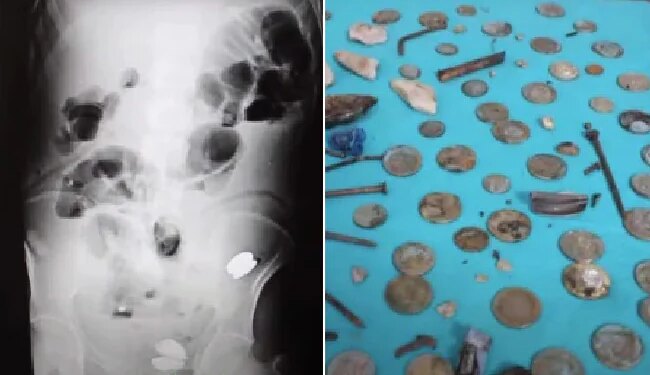 इस शख्स के पेट में 233 सिक्के, बैटरी, चुम्बक, कील और कांच के टुकड़े थे, अभी तक ये ज़िंदा है
