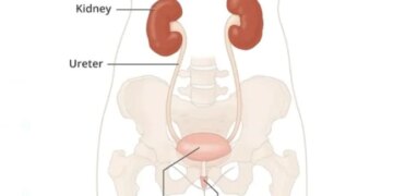 Sir Ganga Ram Hospital Did Wonders By Removing The Patients Left Kidney And Transplanting It On The Right Side
