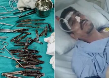 यूपी : मुजफ्फरनगर में एक शख्स के पेट से निकले स्टील के 63 चम्मच, पूरा मामला बना हुआ है संशय