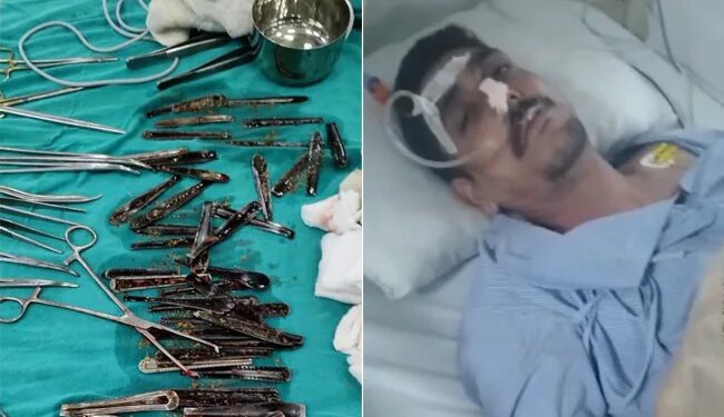यूपी : मुजफ्फरनगर में एक शख्स के पेट से निकले स्टील के 63 चम्मच, पूरा मामला बना हुआ है संशय