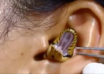 Dangerous Snake Video: Snake Inside The Ear Small Snake Inside The Ear Shocking Footage Viral On Facebook | Snake Entered The Girl Ear
