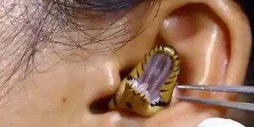 Dangerous Snake Video: Snake Inside The Ear Small Snake Inside The Ear Shocking Footage Viral On Facebook | Snake Entered The Girl Ear