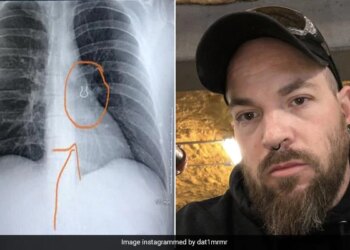 Doctors Found Nose Ring In Man Lungs Which Lost 5 Years Ago See Pics