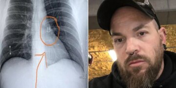Doctors Found Nose Ring In Man Lungs Which Lost 5 Years Ago See Pics