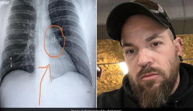 Doctors Found Nose Ring In Man Lungs Which Lost 5 Years Ago See Pics