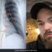 Doctors Found Nose Ring In Man Lungs Which Lost 5 Years Ago See Pics