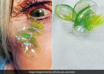 Doctor Removing 23 Contact Lenses From Woman Eye Who Forgot To Take Them Off Shocking Video Viral – डॉक्टर ने महिला की आंख से निकाले 23 कॉन्टैक्ट लेंस, वजह जान उड़े लोगों के होश
