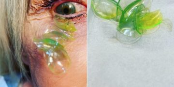 Doctor Removing 23 Contact Lenses From Woman Eye Who Forgot To Take Them Off Shocking Video Viral – डॉक्टर ने महिला की आंख से निकाले 23 कॉन्टैक्ट लेंस, वजह जान उड़े लोगों के होश