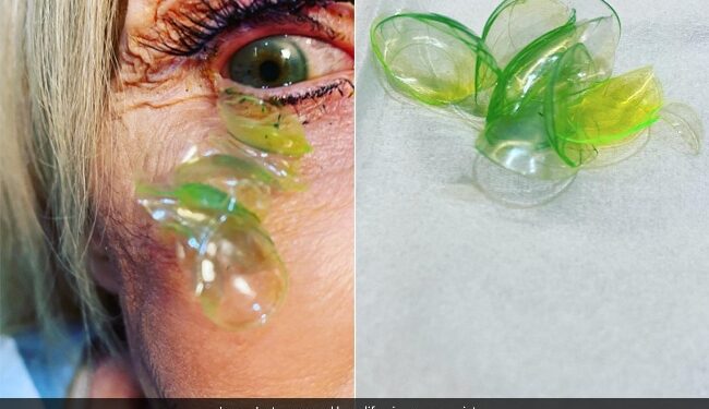 Doctor Removing 23 Contact Lenses From Woman Eye Who Forgot To Take Them Off Shocking Video Viral – डॉक्टर ने महिला की आंख से निकाले 23 कॉन्टैक्ट लेंस, वजह जान उड़े लोगों के होश