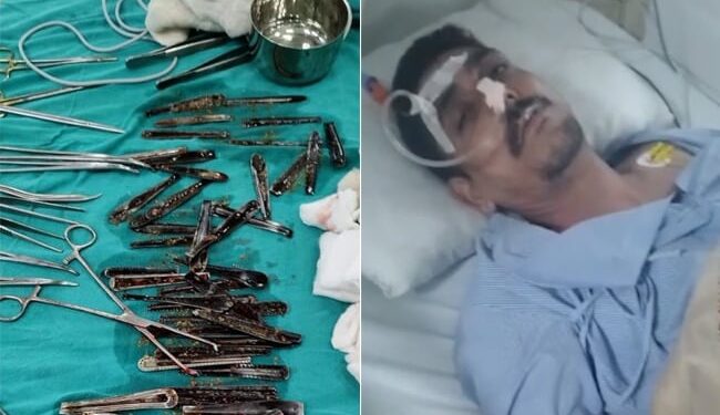 OMG:  यूपी में एक शख्स के पेट से निकले स्टील के 63 चम्मच, अभी भी ये मामला रहस्य बना हुआ है