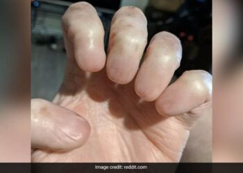 Hand Without Nails Viral Image Of A Man Hand Without Nails Shocks The Internet