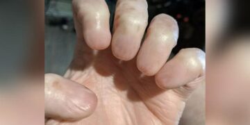 Hand Without Nails Viral Image Of A Man Hand Without Nails Shocks The Internet