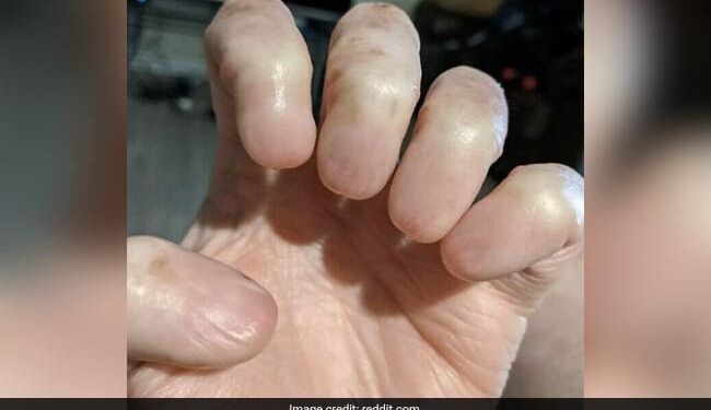 Hand Without Nails Viral Image Of A Man Hand Without Nails Shocks The Internet