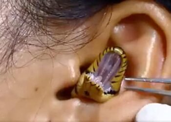 Snake Stuck In Girls Ear, It Is Difficult To Remove, People Are Surprised To See The Video