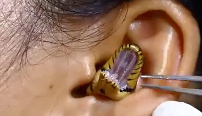 Snake Stuck In Girls Ear, It Is Difficult To Remove, People Are Surprised To See The Video