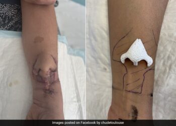 The Doctor Did Wonders, Growing The Nose In His Hand, Transplanting It And Putting It On The Womans Face