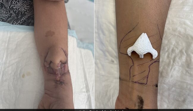 The Doctor Did Wonders, Growing The Nose In His Hand, Transplanting It And Putting It On The Womans Face