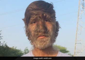 Boy With Rare Werewolf Syndrome In Madhya Pradesh People Call Him Monkey Man Reveals How He Has Been Bullied