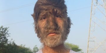Boy With Rare Werewolf Syndrome In Madhya Pradesh People Call Him Monkey Man Reveals How He Has Been Bullied