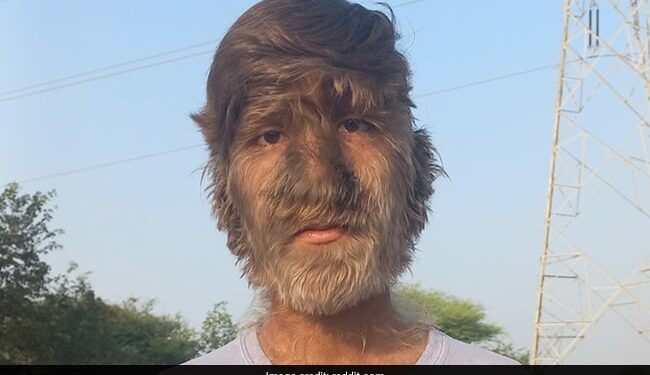 Boy With Rare Werewolf Syndrome In Madhya Pradesh People Call Him Monkey Man Reveals How He Has Been Bullied