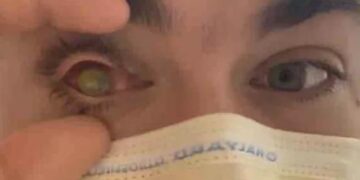 OMG, One Eye Of The Boy Disappeared Overnight, He Slept In A Deep Sleep, The Eye Was Not There In The Morning Ndtv Hindi Ndtv India