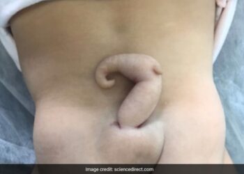 Baby Girl Was Born With 6 Cm Tail, Doctors Were Surprised To See, Read Full Story Ndtv Hindi Ndtv India