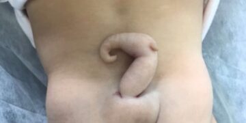 Baby Girl Was Born With 6 Cm Tail, Doctors Were Surprised To See, Read Full Story Ndtv Hindi Ndtv India