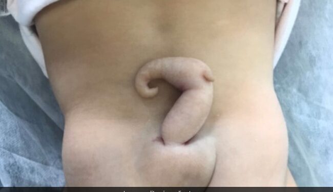 Baby Girl Was Born With 6 Cm Tail, Doctors Were Surprised To See, Read Full Story Ndtv Hindi Ndtv India