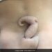 Baby Girl Was Born With 6 Cm Tail, Doctors Were Surprised To See, Read Full Story Ndtv Hindi Ndtv India