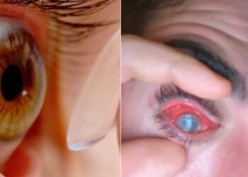 Shocking: Man Fell Asleep With Contact Lenses On, Flesh Eating Parasites Eat His Eye, Parasites Eat Mans Eyes During Sleeping With Contact Lenses