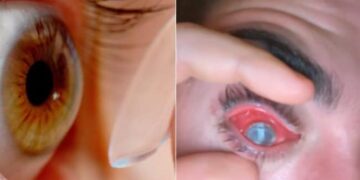 Shocking: Man Fell Asleep With Contact Lenses On, Flesh Eating Parasites Eat His Eye, Parasites Eat Mans Eyes During Sleeping With Contact Lenses