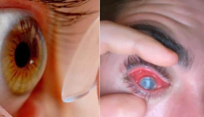 Shocking: Man Fell Asleep With Contact Lenses On, Flesh Eating Parasites Eat His Eye, Parasites Eat Mans Eyes During Sleeping With Contact Lenses