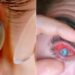 Shocking: Man Fell Asleep With Contact Lenses On, Flesh Eating Parasites Eat His Eye, Parasites Eat Mans Eyes During Sleeping With Contact Lenses