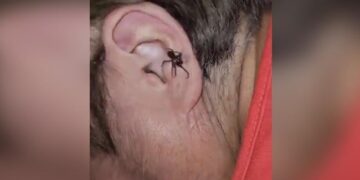 Live Spider Crawling Out Of A Man Ear You Will Get Goosebumps Watch Hair Raising Video